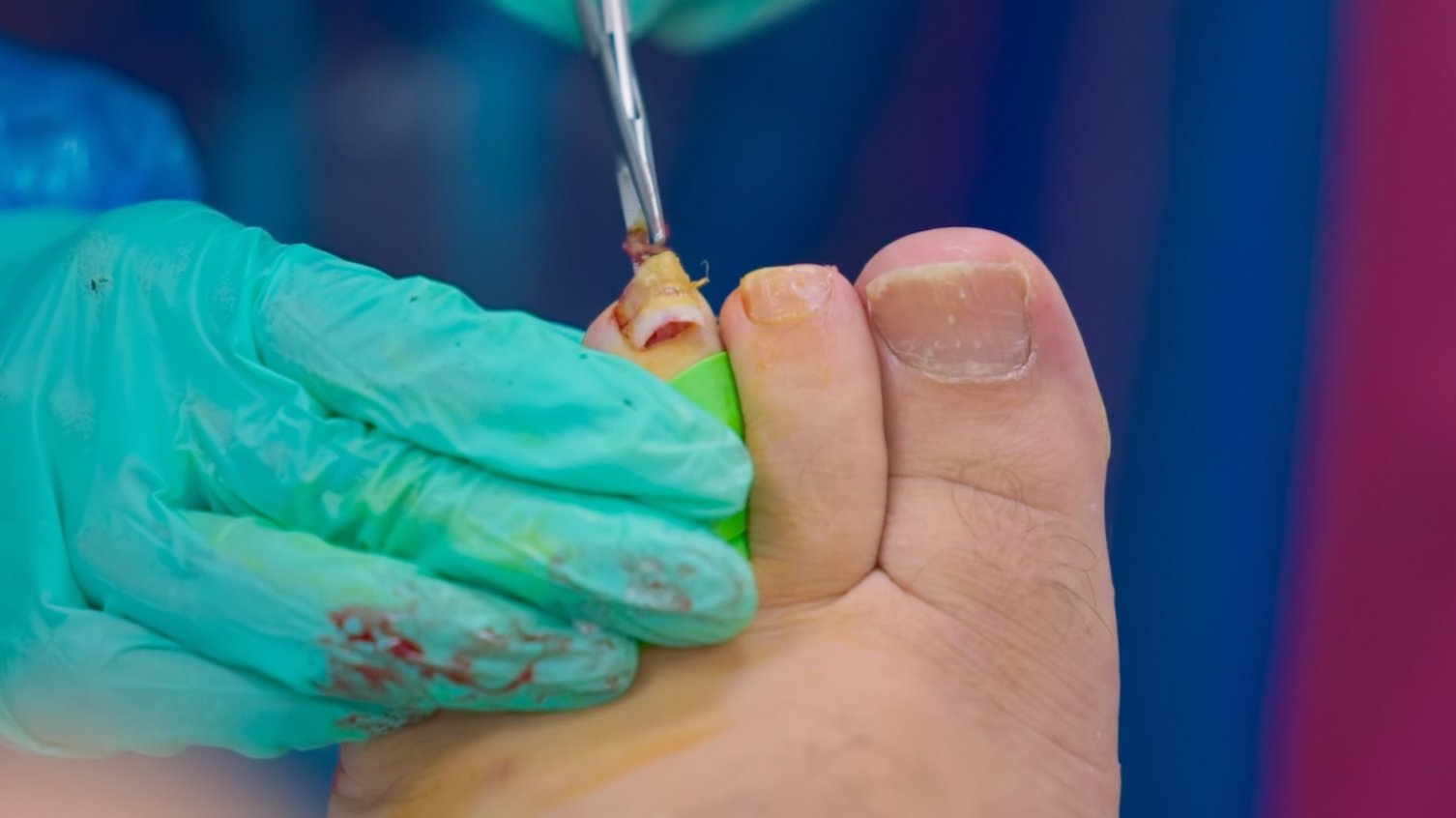 Craig has 7 of his toenails popped off (Picture: Discovery+/12 Yard Productions)